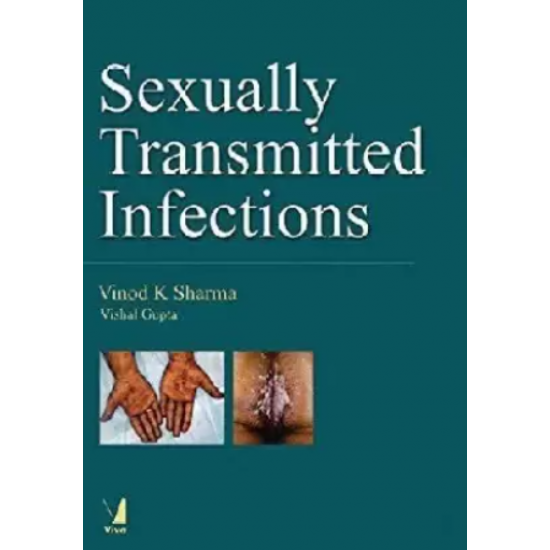 Sexually Transmitted Infections by Vinod K Sharma Vishal Gupta